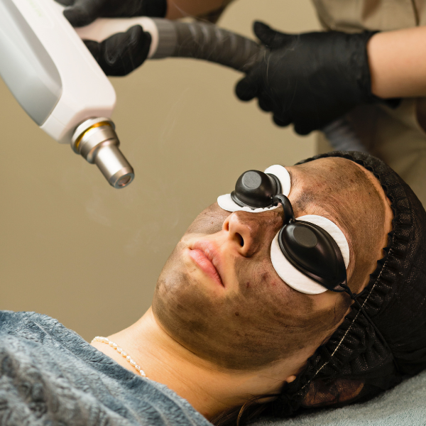 Carbon Facial - 30  Mins