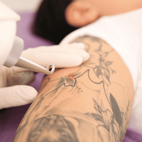 Tattoo Removal 50Cm2 - 15  Mins