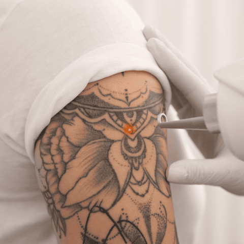 Tattoo Removal 75Cm2 - 15  Mins