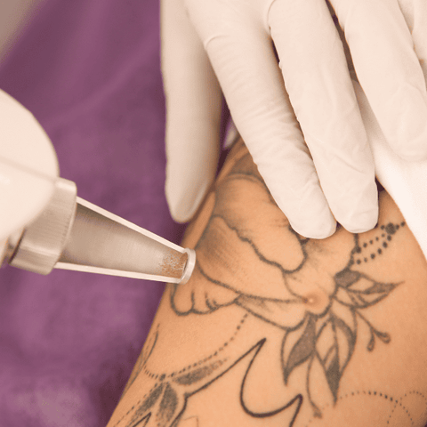 Tattoo Removal Consultation - 30  Mins