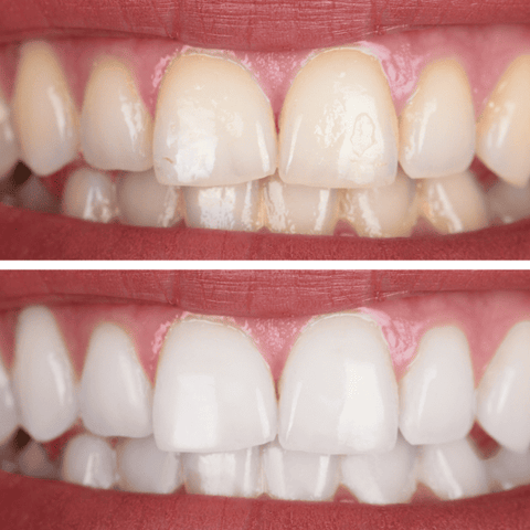 Teeth Whitening - 50  Mins