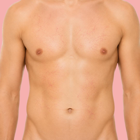 Vascular Removal - Chest & Stomach - 60  Mins