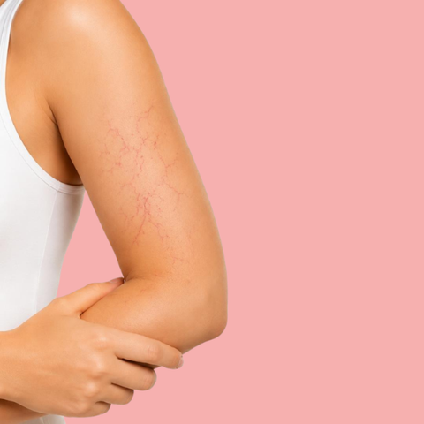 Vascular Removal - Full Arms - 60  Mins