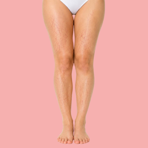 Vascular Removal - Full Legs - 120  Mins