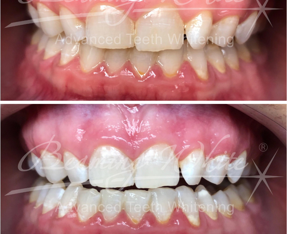 Teeth Whitening - Adorn Laser Clinic and Hair Dressing